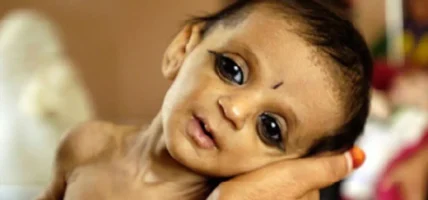 कुपोषित बालबालिकालाई स्वस्थ बनाउँदै रुम्जाटार अस्पताल