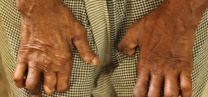 झापामा ६ बालबालिकासहित ६६ जना नयाँ कुष्ठरोगी फेला